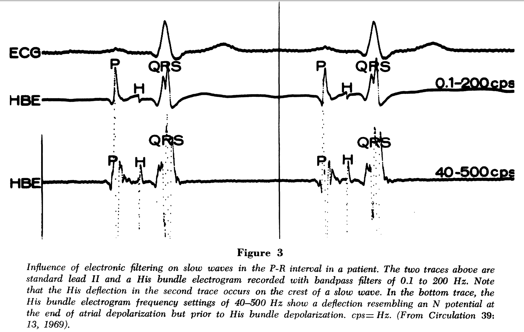 Bundle of HIS junctional rhythm ecg from