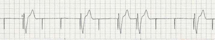 pacemaker failure to capture ecg strip
