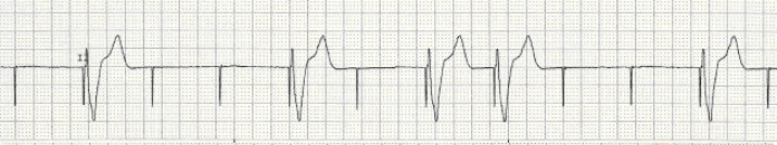 ventricular paced failure to capture