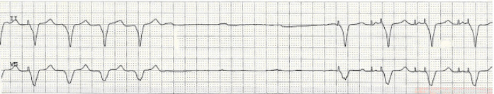 pacemaker failure to fire ecg strip