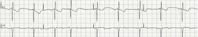 ventricular paced rhythm with failure to capture