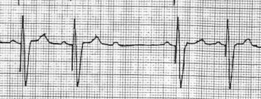 pacemaker oversensing ecg strip