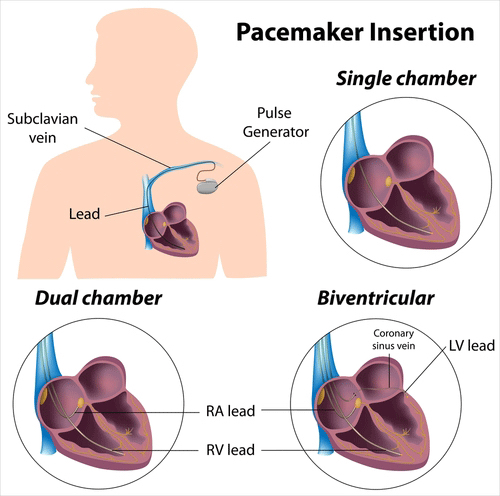 pacemaker implant