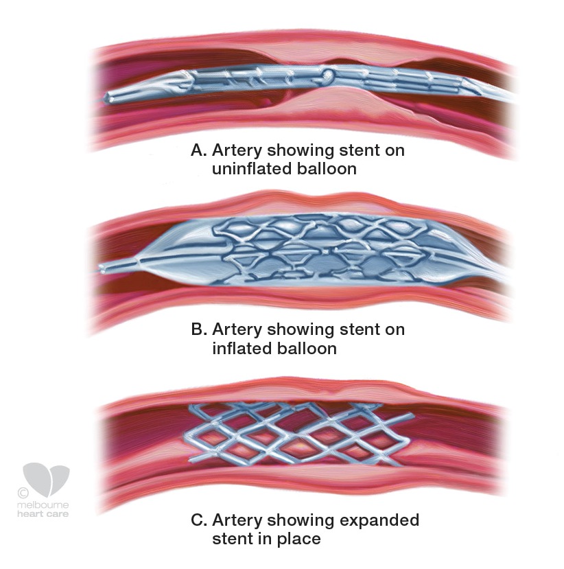 coronary stent diagram